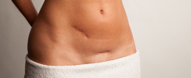 scar massage image