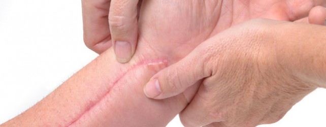 surgical scar