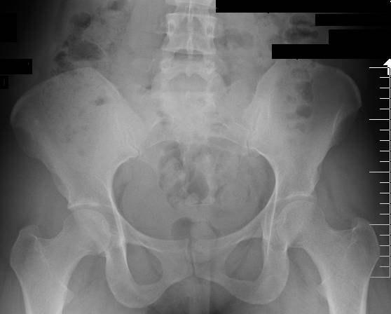 poor pelvic alignment