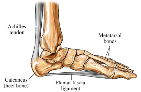plantar fasciitis