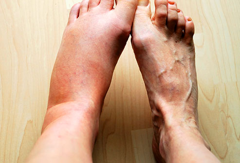 inflammation of one foot