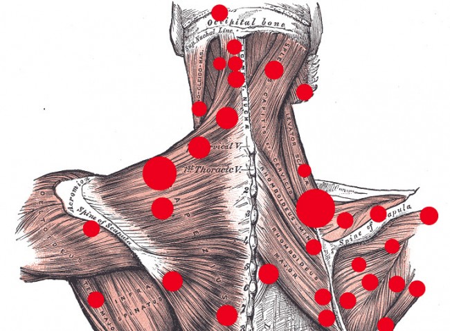 trigger point
