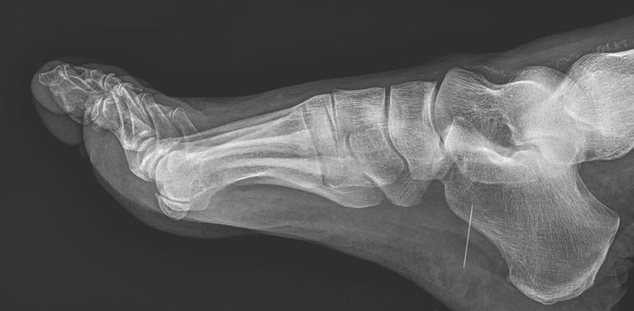 plantar fascia picture