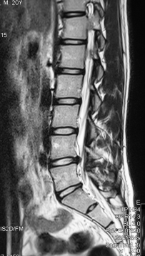 herniated disc x-ray