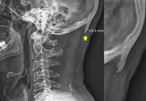 external occipital protuberance