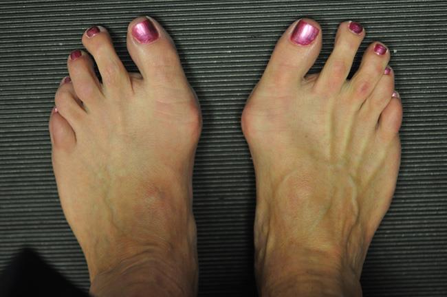 bunions